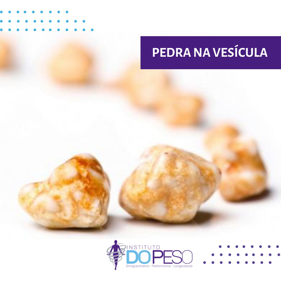 Cálculo Na Vesícula , Pedra na vesícula: o que é, sintomas, causas e ...